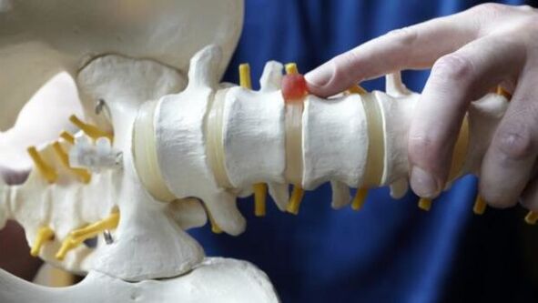 ernia spinale come causa di mal di schiena