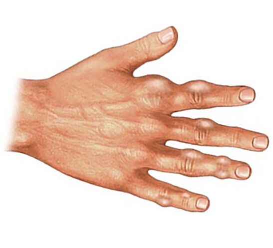 Deposizione di cristalli di acido urico nei tessuti molli delle dita con artrite gottosa