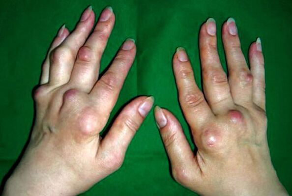 Mani affette da poliosteoartrite deformante