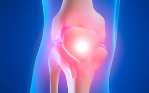 cause di artrosi dell'articolazione del ginocchio