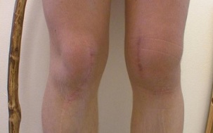 fasi di sviluppo dell'artrosi del ginocchio