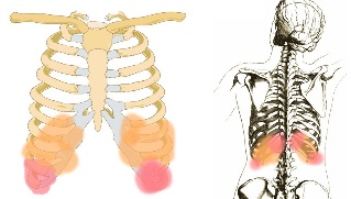 mal di schiena sotto le costole sintomi