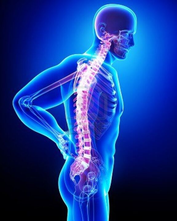 Colonna vertebrale umana affetta da osteocondrosi